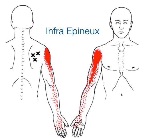 Schéma de douleur référée de l'infra-épineux — points gâchette dans la fosse sous-épineuse de la scapula, douleur projetée en face antérieure de l'épaule et descendant le long du bras jusqu'à la main. Source : Travell & Simons.