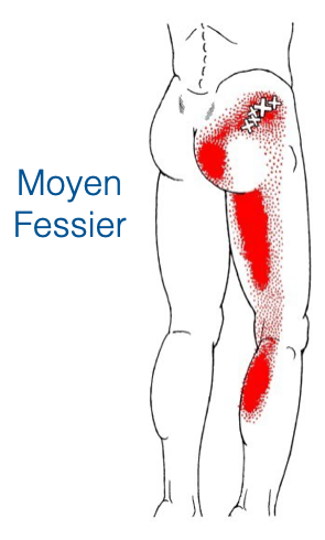Schéma de douleur référée du moyen fessier — points gâchette dans la région glutéale latérale, douleur projetée vers la région lombo-sacrée, la crête iliaque et la face latérale de la cuisse. Source : Travell & Simons.