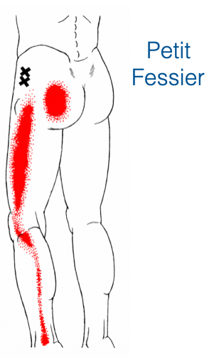 Schéma de douleur référée du petit fessier — points gâchette dans la région glutéale, douleur projetée descendant tout le long de la face latérale et postérieure du membre inférieur jusqu'à la cheville (pseudo-sciatique). Source : Travell & Simons.
