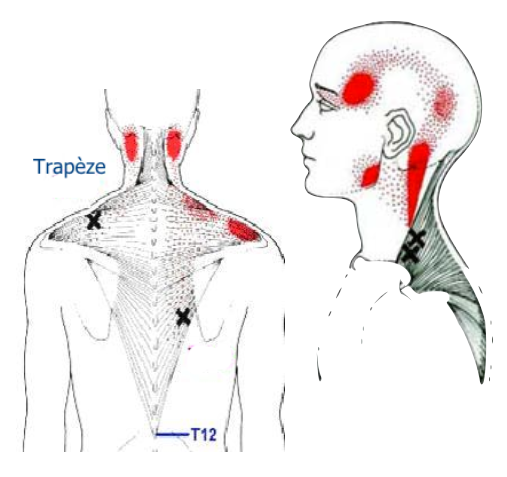 Schéma de douleur référée du trapèze supérieur — points gâchette au-dessus de l'épaule, douleur projetée vers la tempe, l'angle de la mâchoire, l'arrière du crâne et l'œil. Source : Travell & Simons.